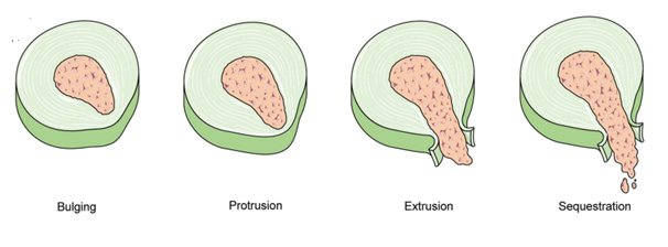 Characteristics and mechanisms of resorption in lumbar disc herniation, Arthritis Research & Therapy