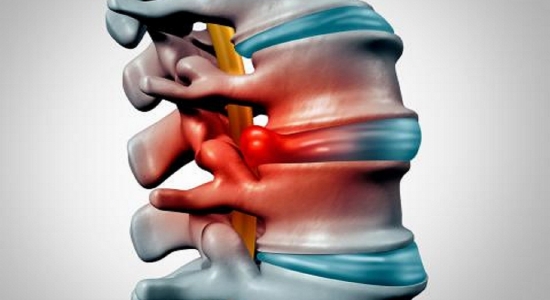 El 66% DE LAS HERNIAS DE DISCO SE REABSORBEN CON UN TRATAMIENTO CONSERVADOR