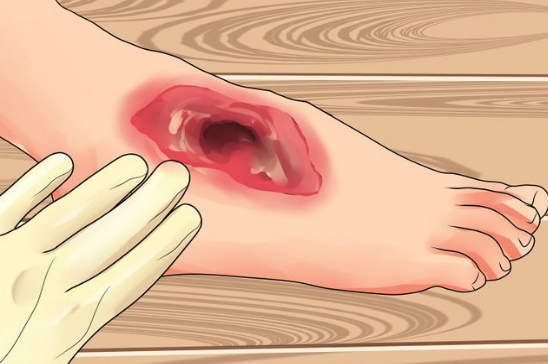 CICATRIZACIÓN DE ÚLCERAS MEDIANTE ELECTROESTIMULACIÓN