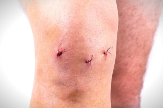 LESIONES DEL MENISCO