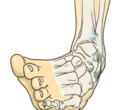 ¿QUÉ HACER EN CASO DE SUFRIR UN ESGUINCE DE TOBILLO?
