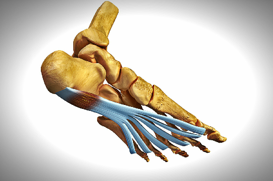 FASCITIS PLANTAR (Dolor en la planta del pie)